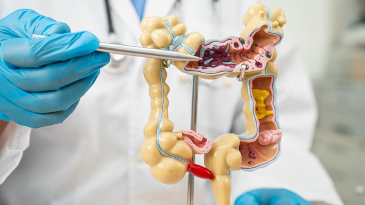 Colorectal cancer