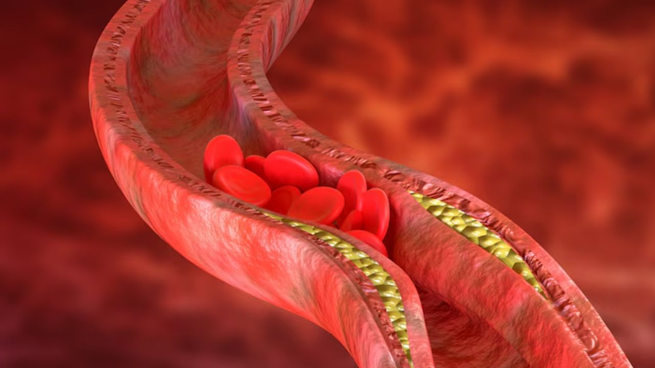 High cholesterol symptoms