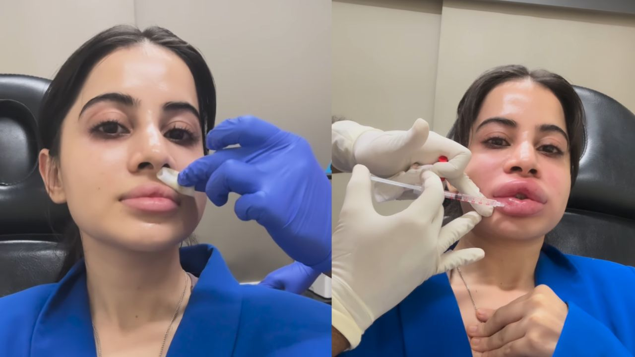 urfi javed lip filler surgery