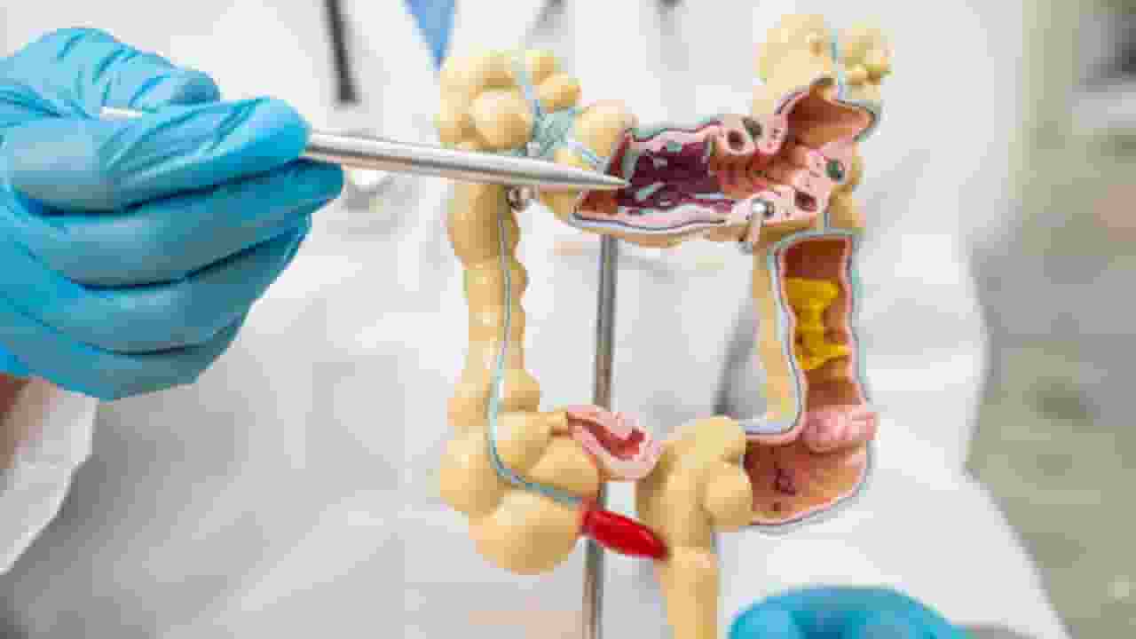 Colorectal cancer