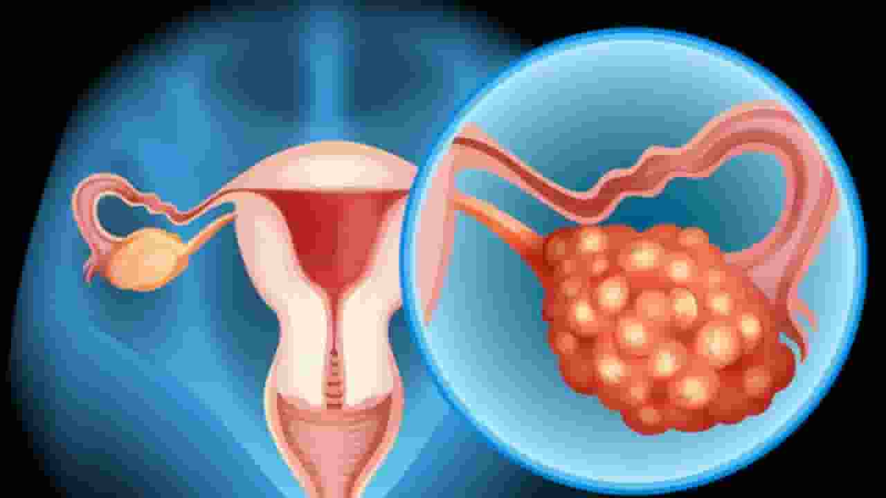 ovarian cancer