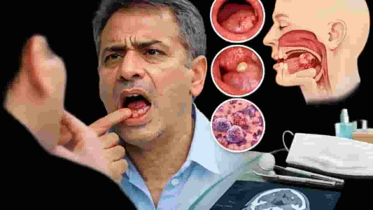 mouth cancer