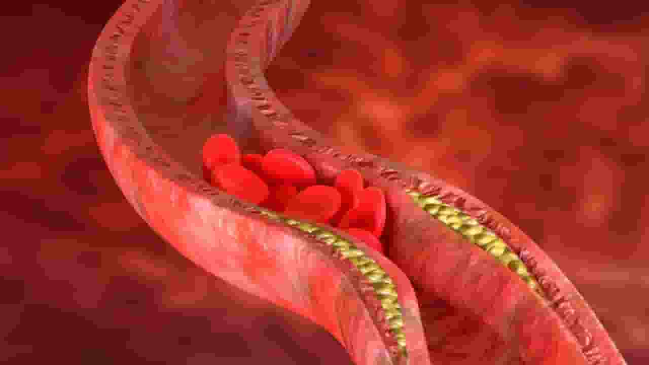 High cholesterol symptoms