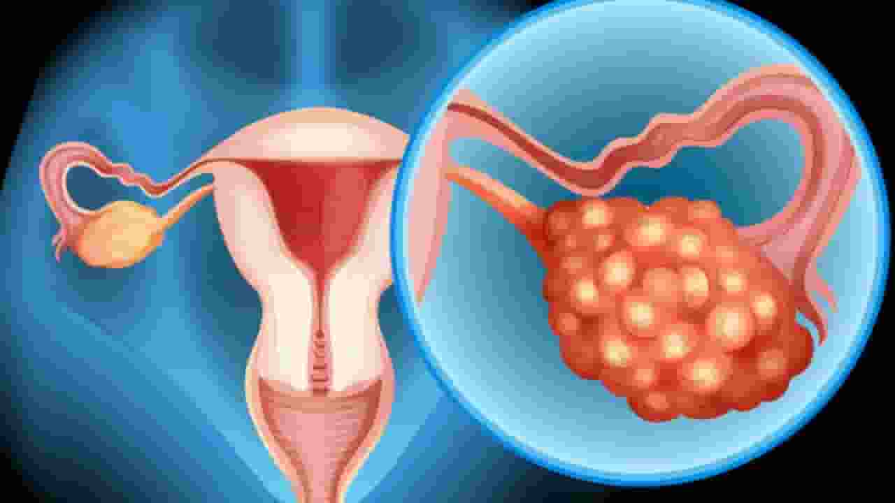 ovarian cancer