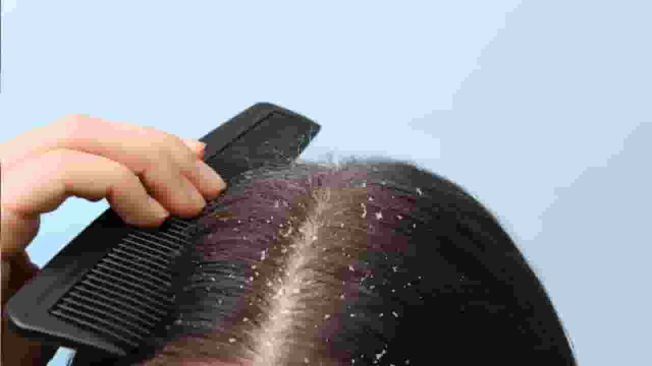 Hair Dandruff, Photo Credit: Freepik