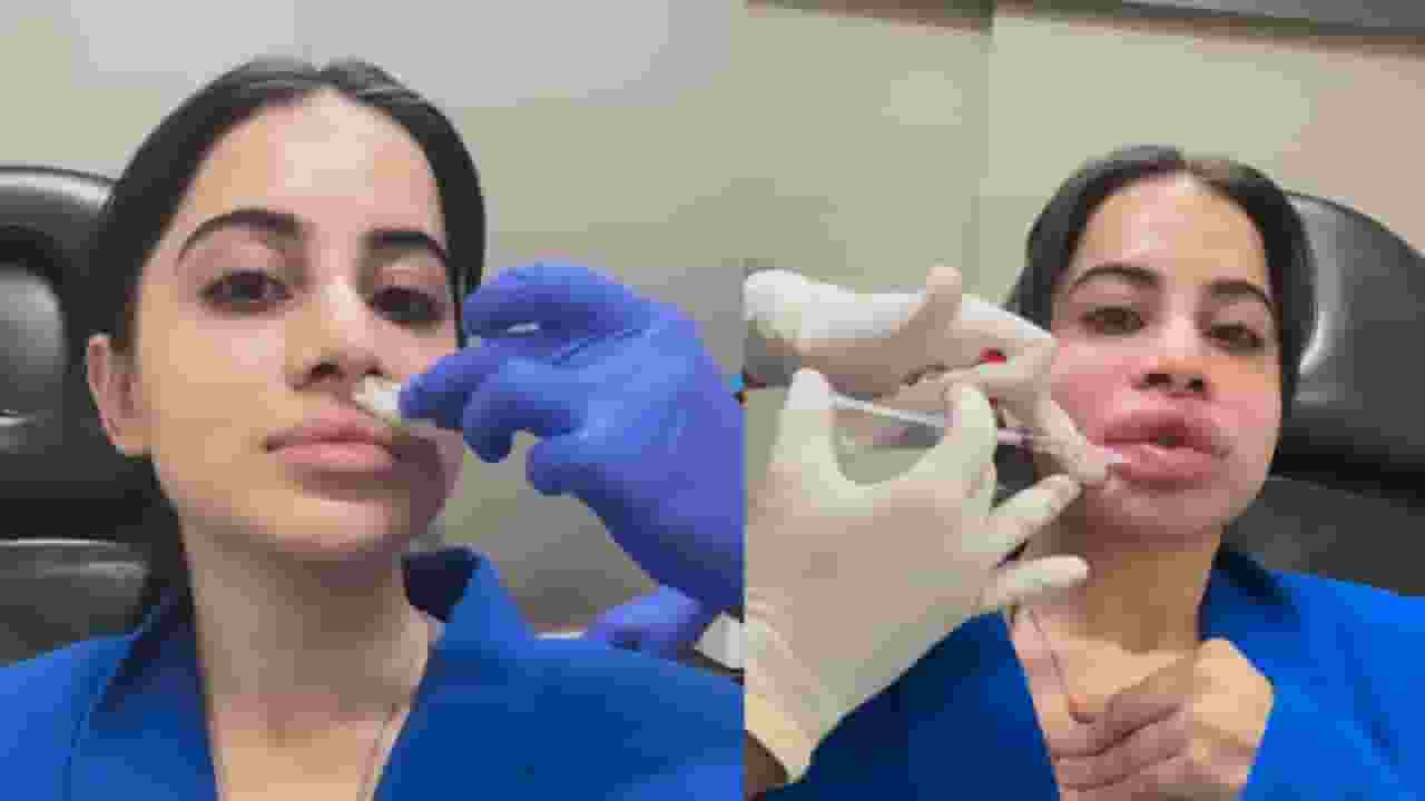 सूजे होंठ, लाल चेहरा, उर्फी ने हटाए लिप फिलर्स, क्या है यह बला? urfi javed lip filler surgery